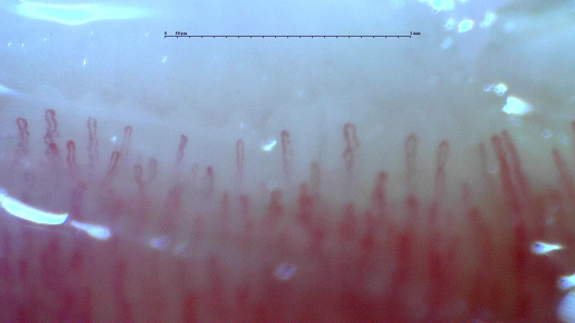Nailfold capillaroscopy: right index finger, field c. Normal Pattern: Representative Case.