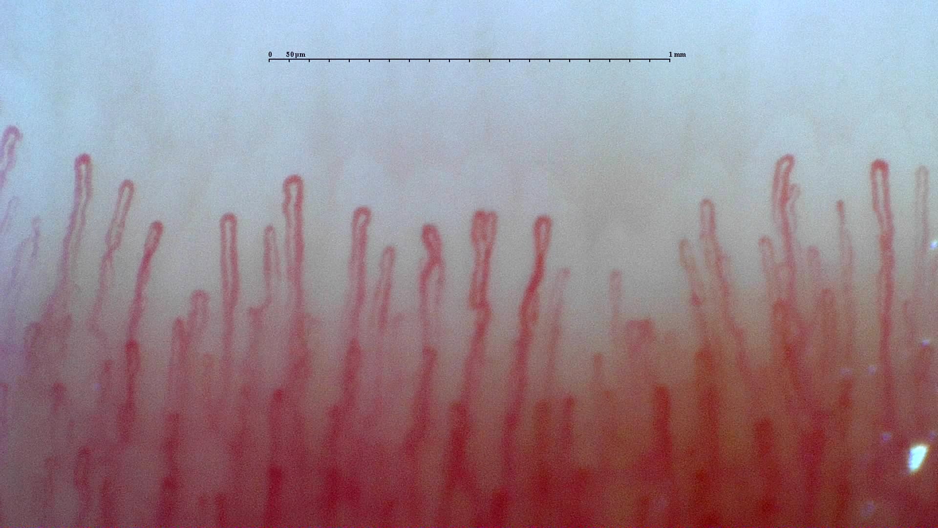 Nailfold capillaroscopy: right ring finger, field c. Normal Pattern: Representative Case.