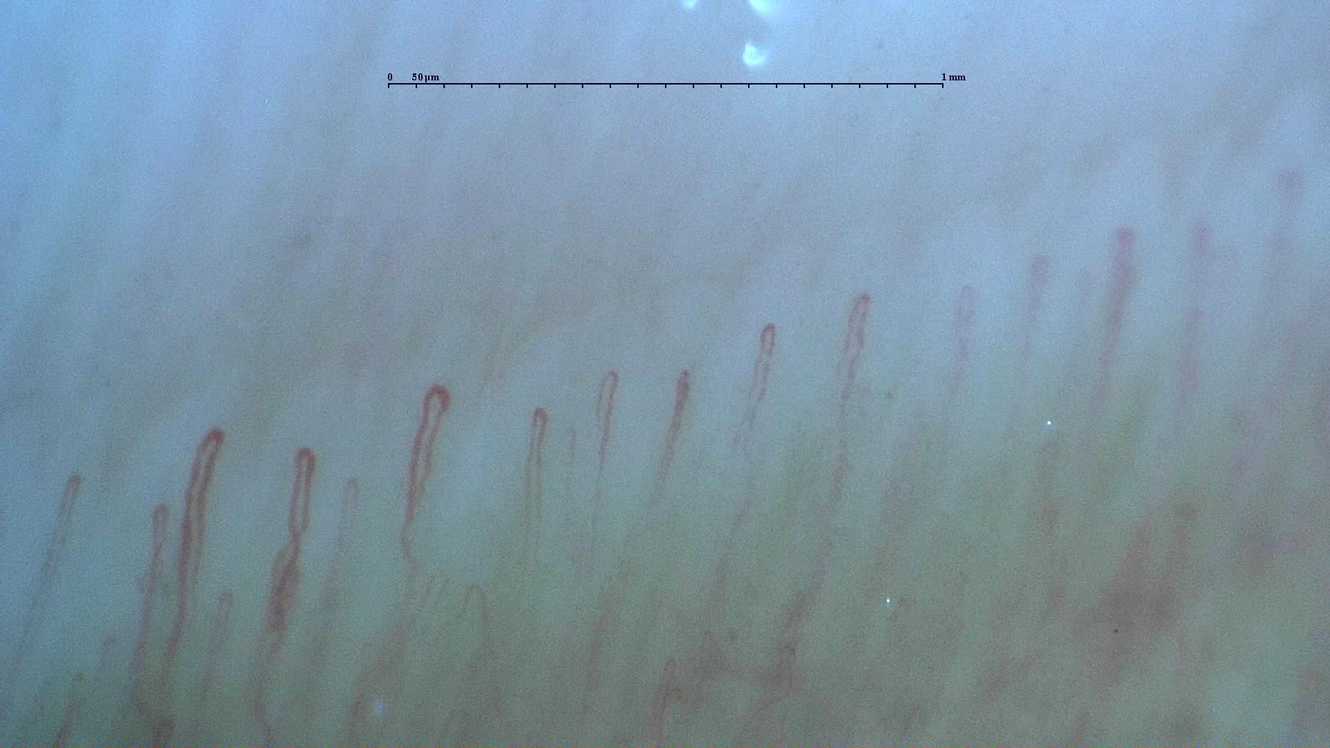 Nailfold capillaroscopy: left ring finger, field a. Normal Pattern: Representative Case.