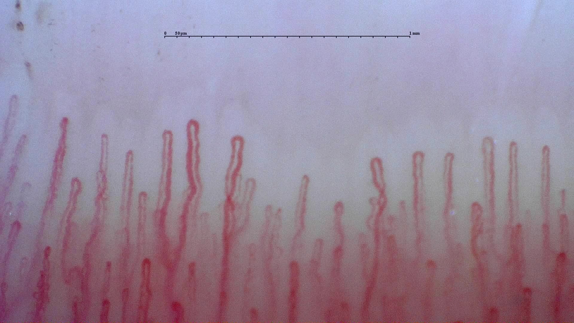 Nailfold capillaroscopy: right little finger, field c. Normal Pattern: Representative Case.