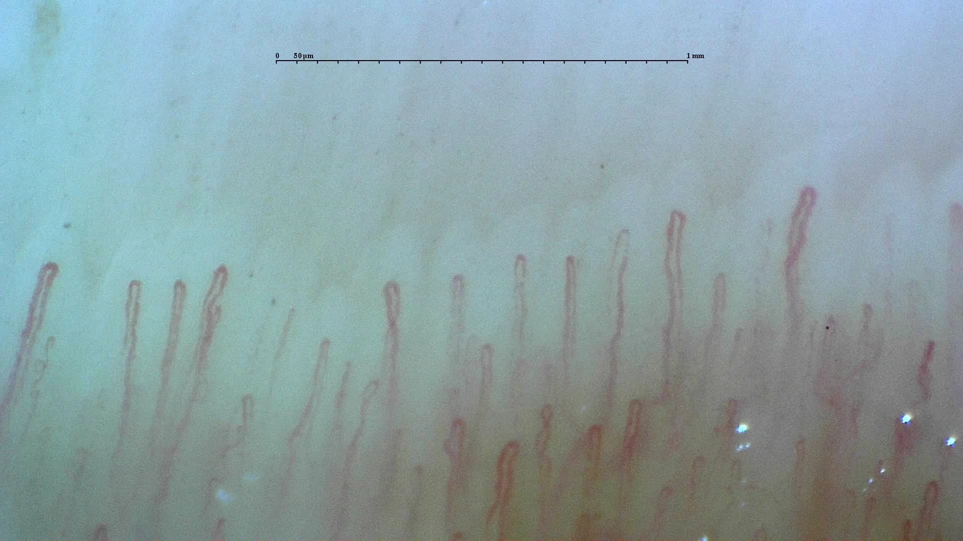 Nailfold capillaroscopy: left middle finger, field a. Normal Pattern: Representative Case.