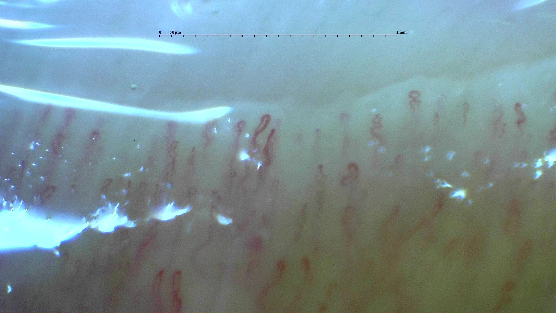 Nailfold capillaroscopy: right index finger, field b. Normal Pattern: Representative Case.