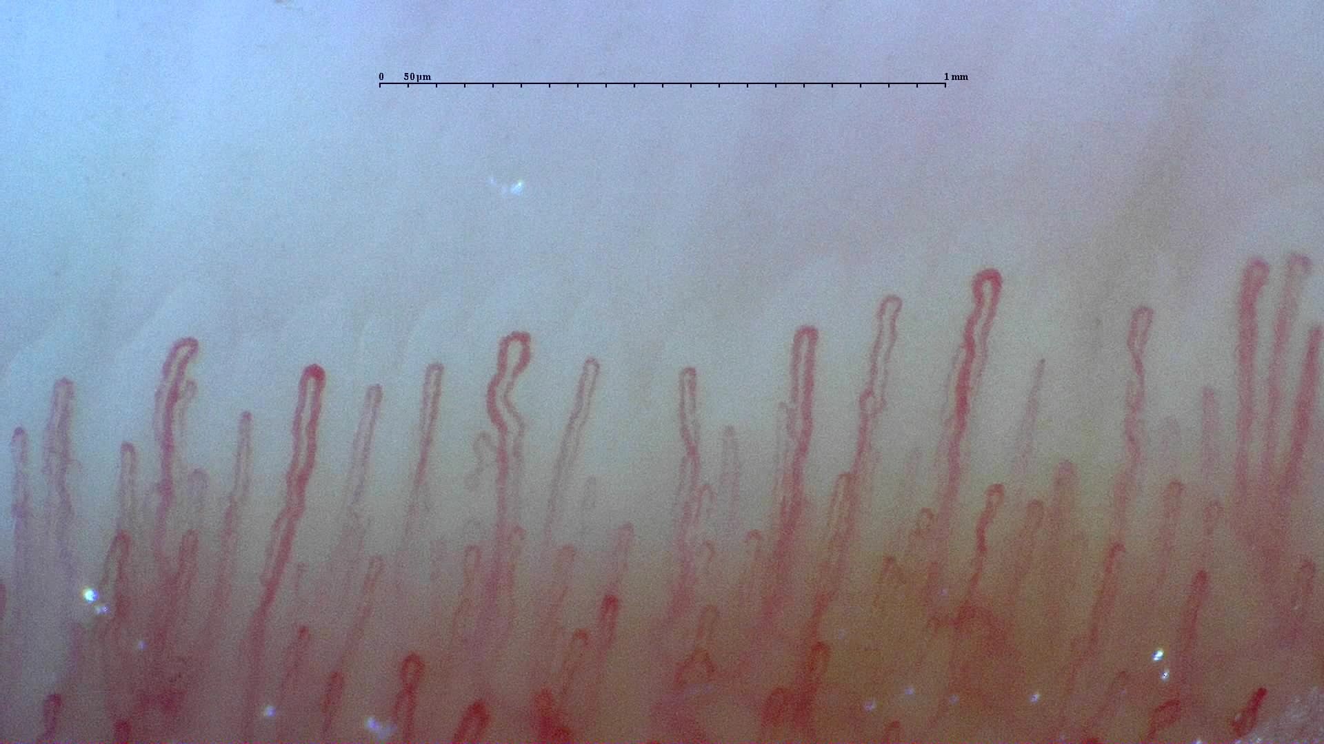 Nailfold capillaroscopy: right ring finger, field b. Normal Pattern: Representative Case.