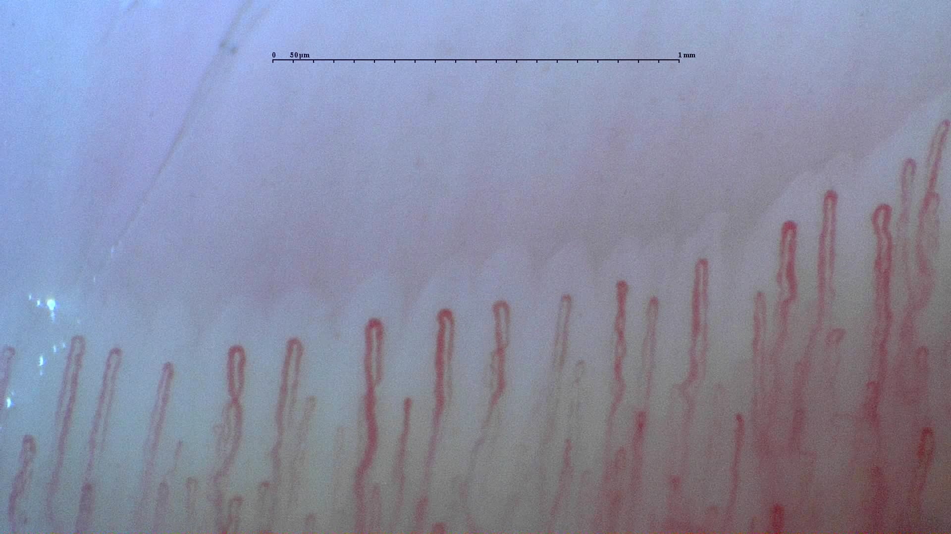 Nailfold capillaroscopy: right little finger, field b. Normal Pattern: Representative Case.