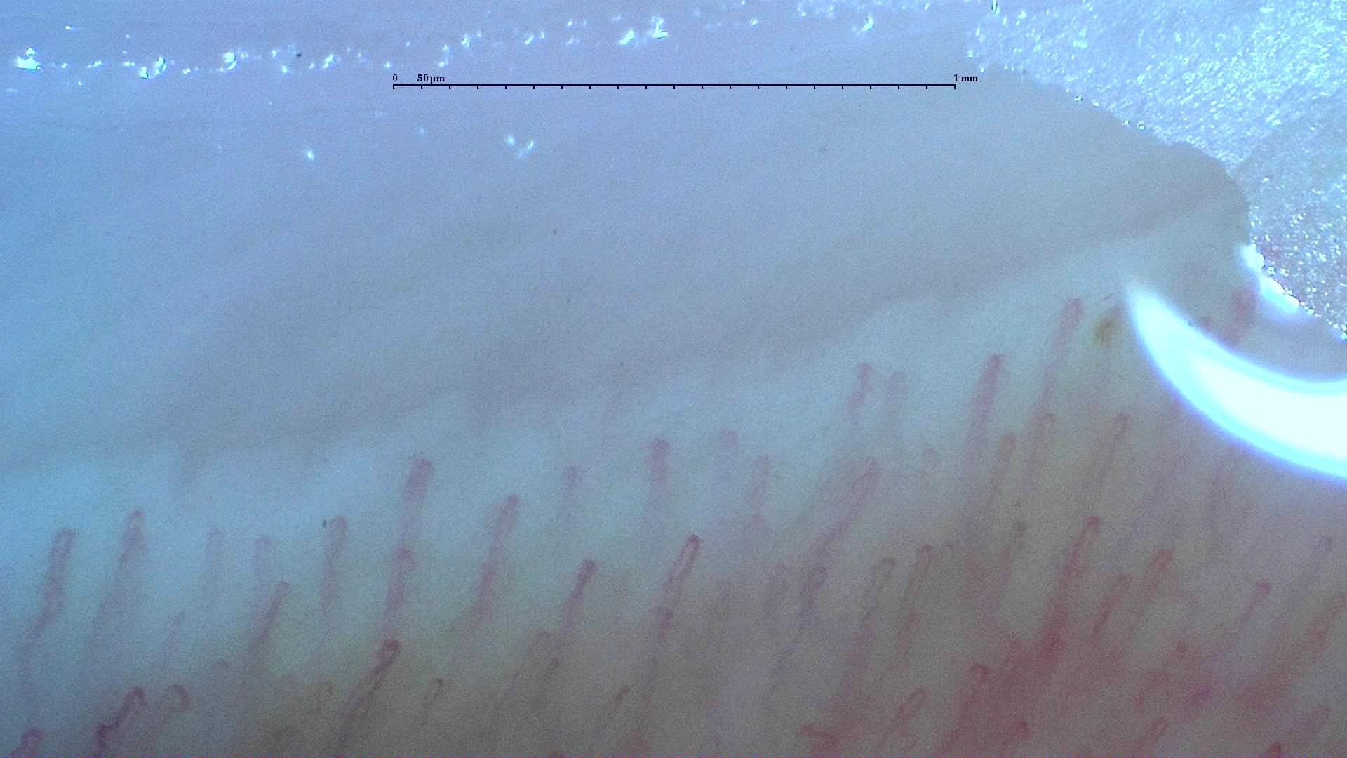 Nailfold capillaroscopy: right middle finger, field b. Normal Pattern: Representative Case.