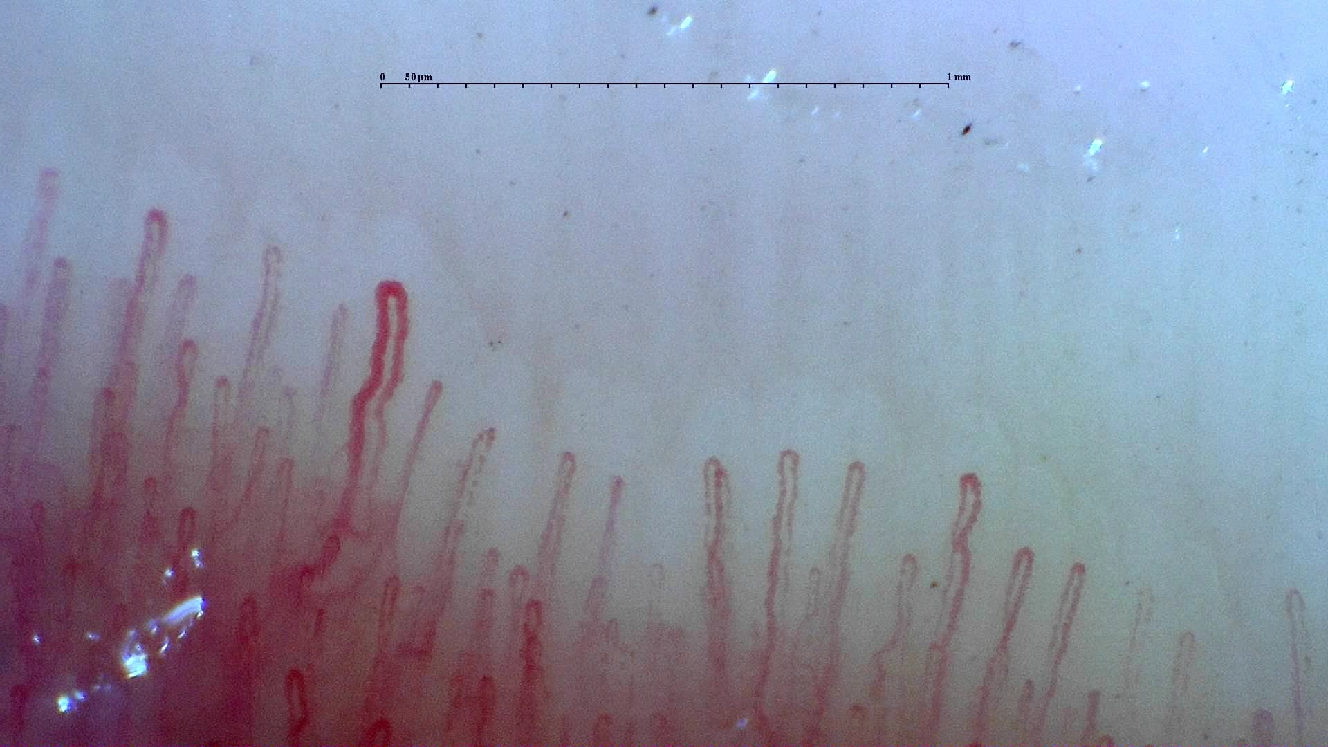 Nailfold capillaroscopy: left middle finger, field c. Normal Pattern: Representative Case.