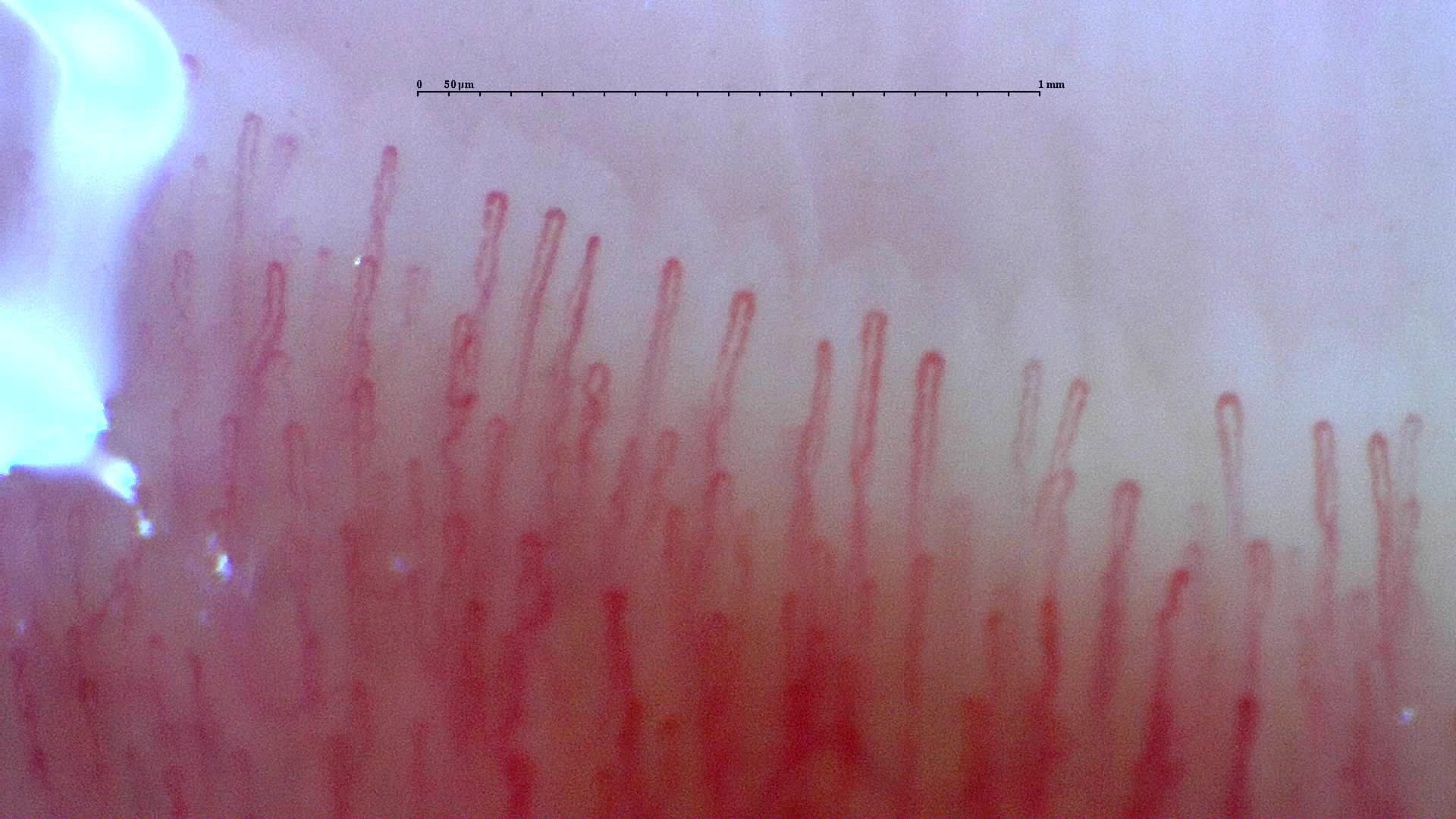 Nailfold capillaroscopy: left ring finger, field c. Normal Pattern: Representative Case.
