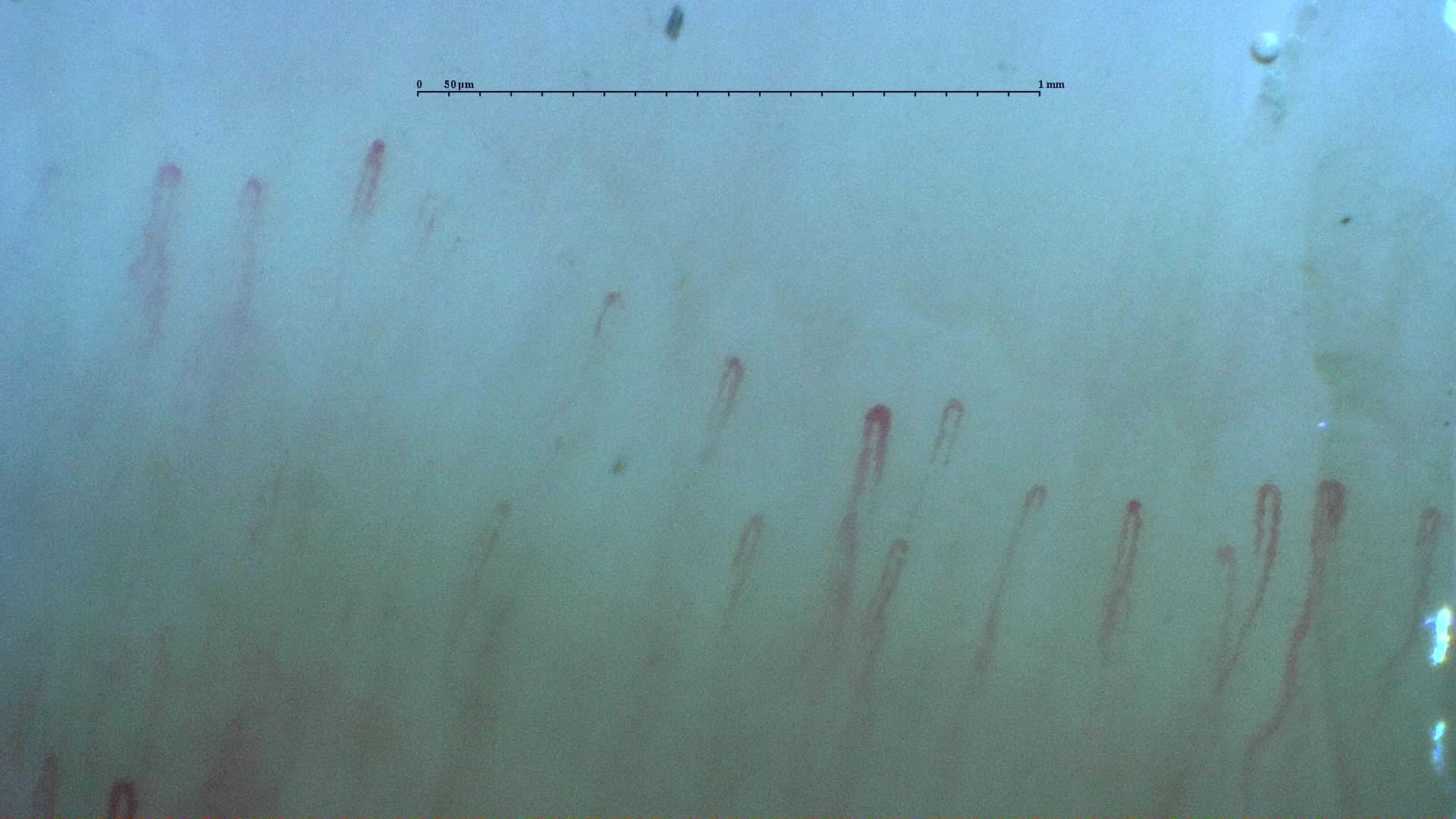Nailfold capillaroscopy: left index finger, field b. Normal Pattern: Representative Case.
