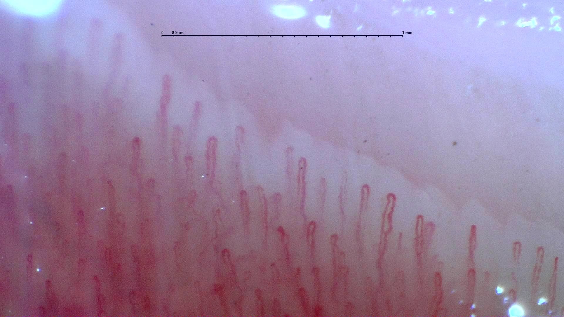 Nailfold capillaroscopy: left ring finger, field d. Normal Pattern: Representative Case.