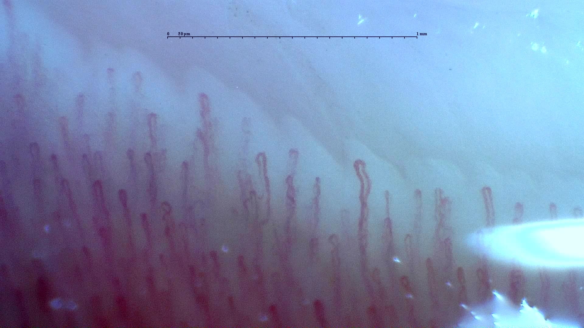 Nailfold capillaroscopy: right ring finger, field a. Normal Pattern: Representative Case.