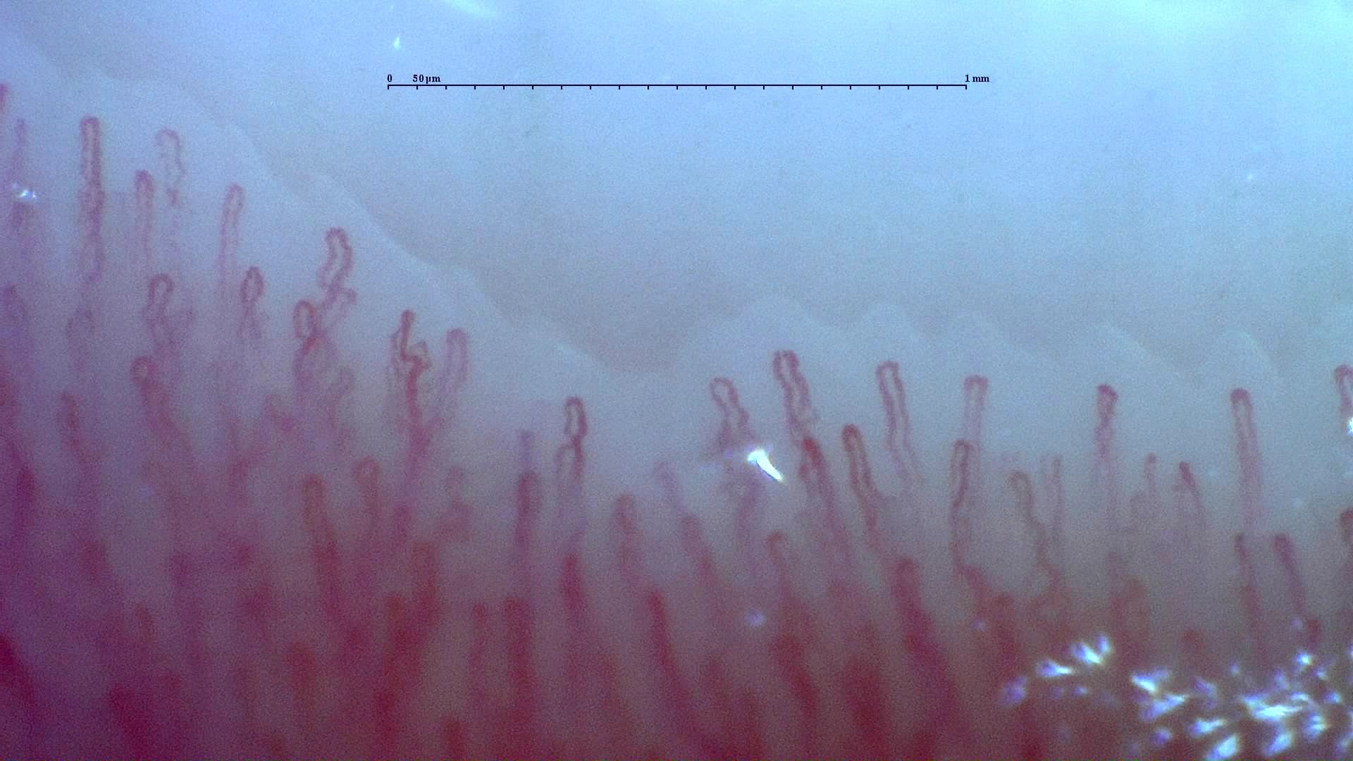 Nailfold capillaroscopy: right index finger, field d. Normal Pattern: Representative Case.