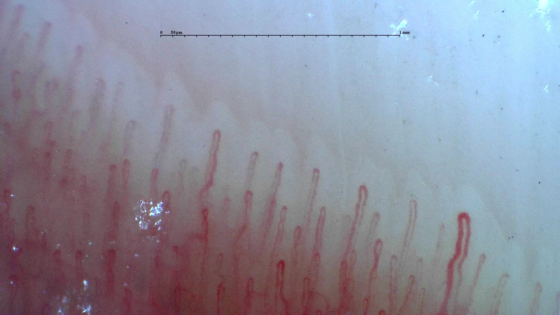 Nailfold capillaroscopy: left middle finger, field d. Normal Pattern: Representative Case.
