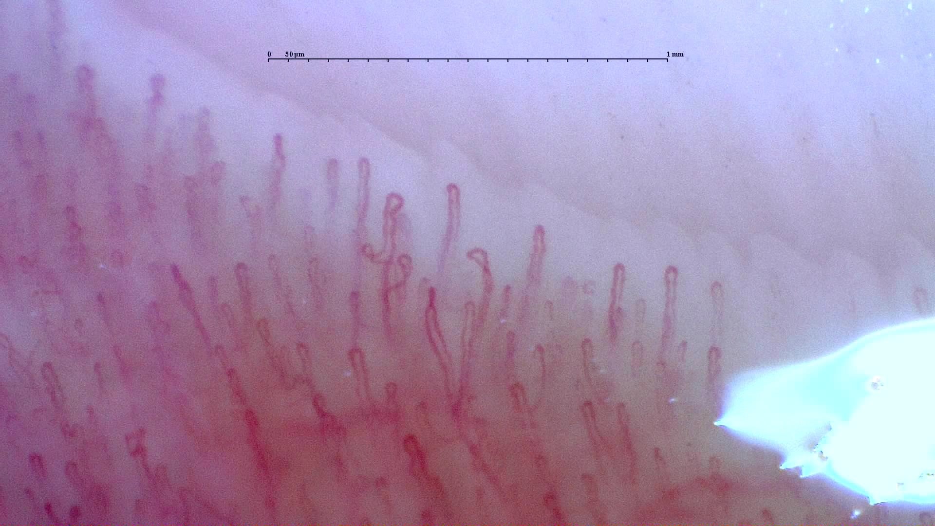 Nailfold capillaroscopy: left little finger, field d. Normal Pattern: Representative Case.