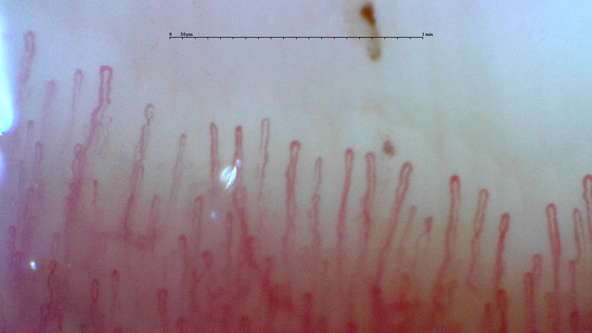 Nailfold capillaroscopy: right ring finger, field d. Normal Pattern: Representative Case.