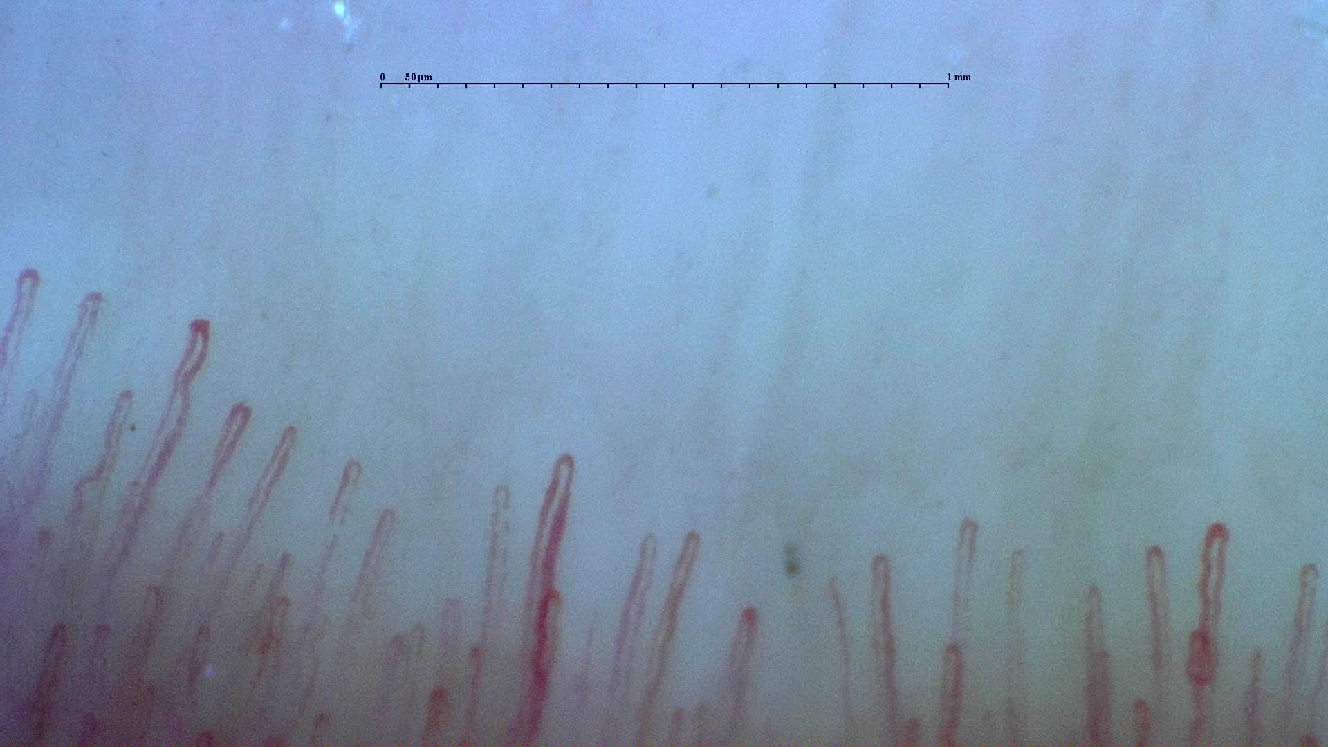 Nailfold capillaroscopy: left middle finger, field b. Normal Pattern: Representative Case.