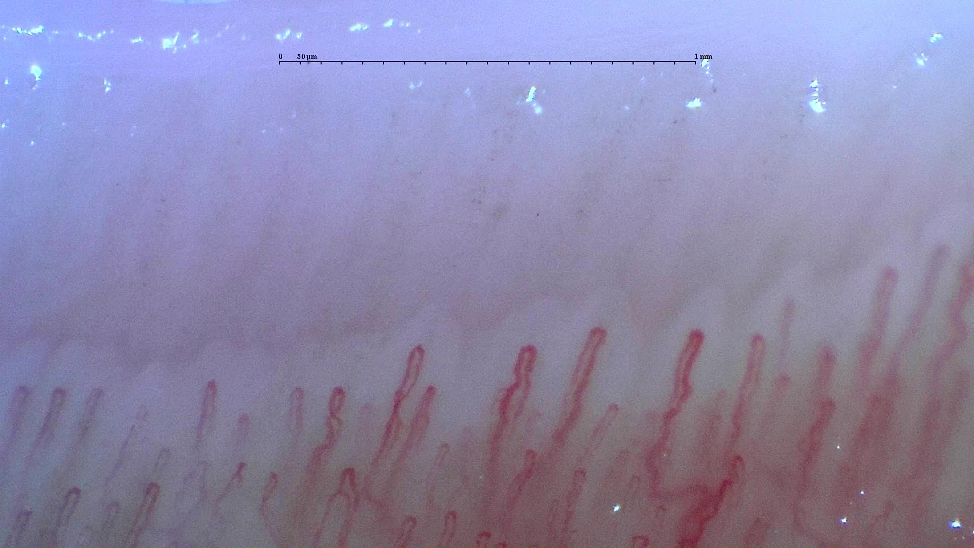 Nailfold capillaroscopy: left little finger, field a. Normal Pattern: Representative Case.