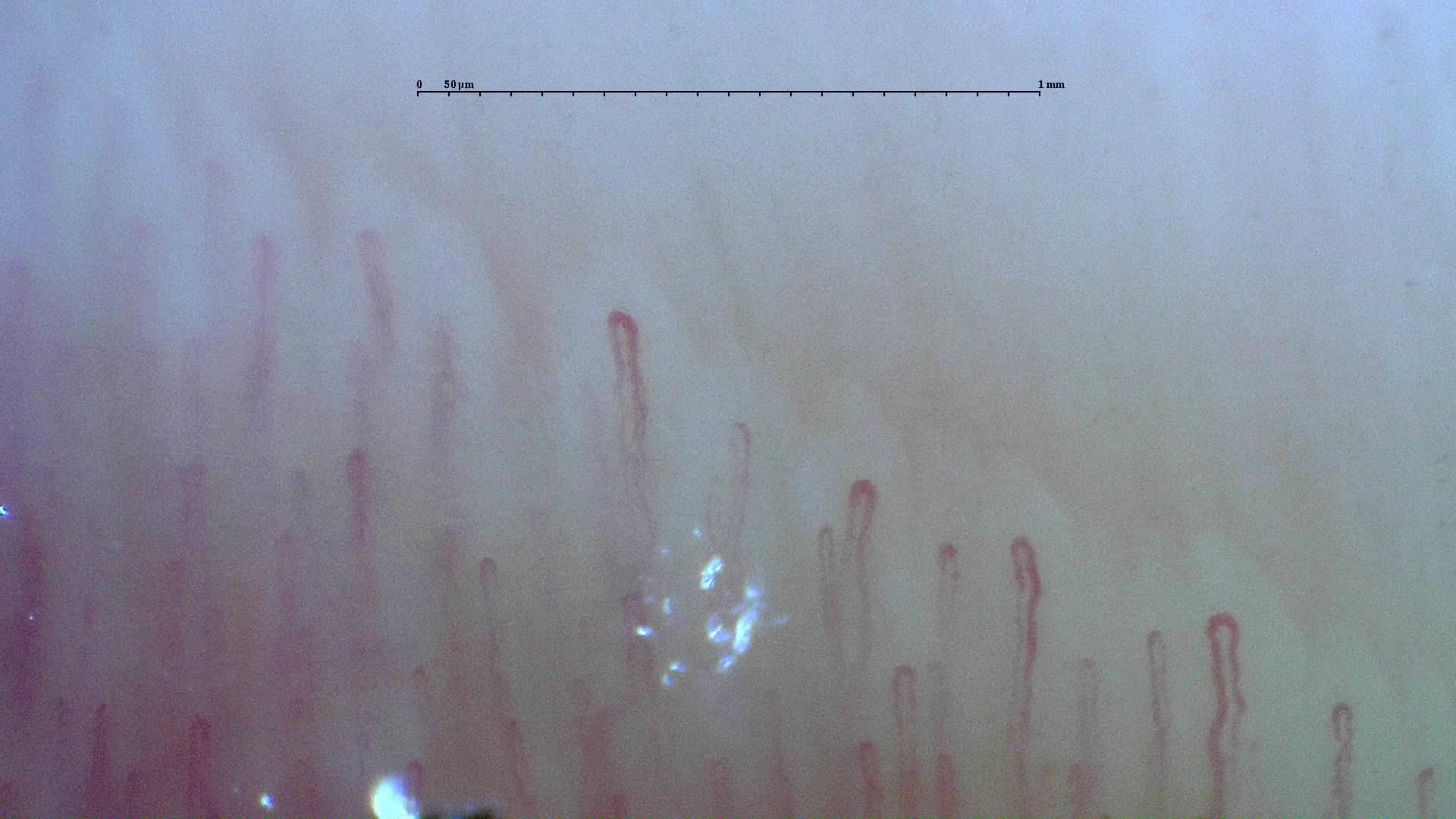 Nailfold capillaroscopy: right little finger, field a. Normal Pattern: Representative Case.