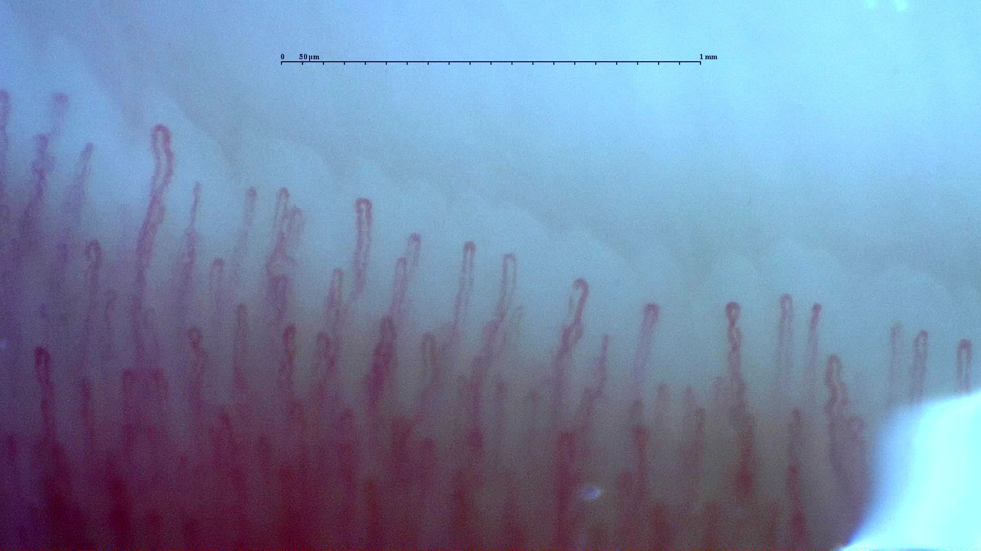 Nailfold capillaroscopy: right middle finger, field d. Normal Pattern: Representative Case.