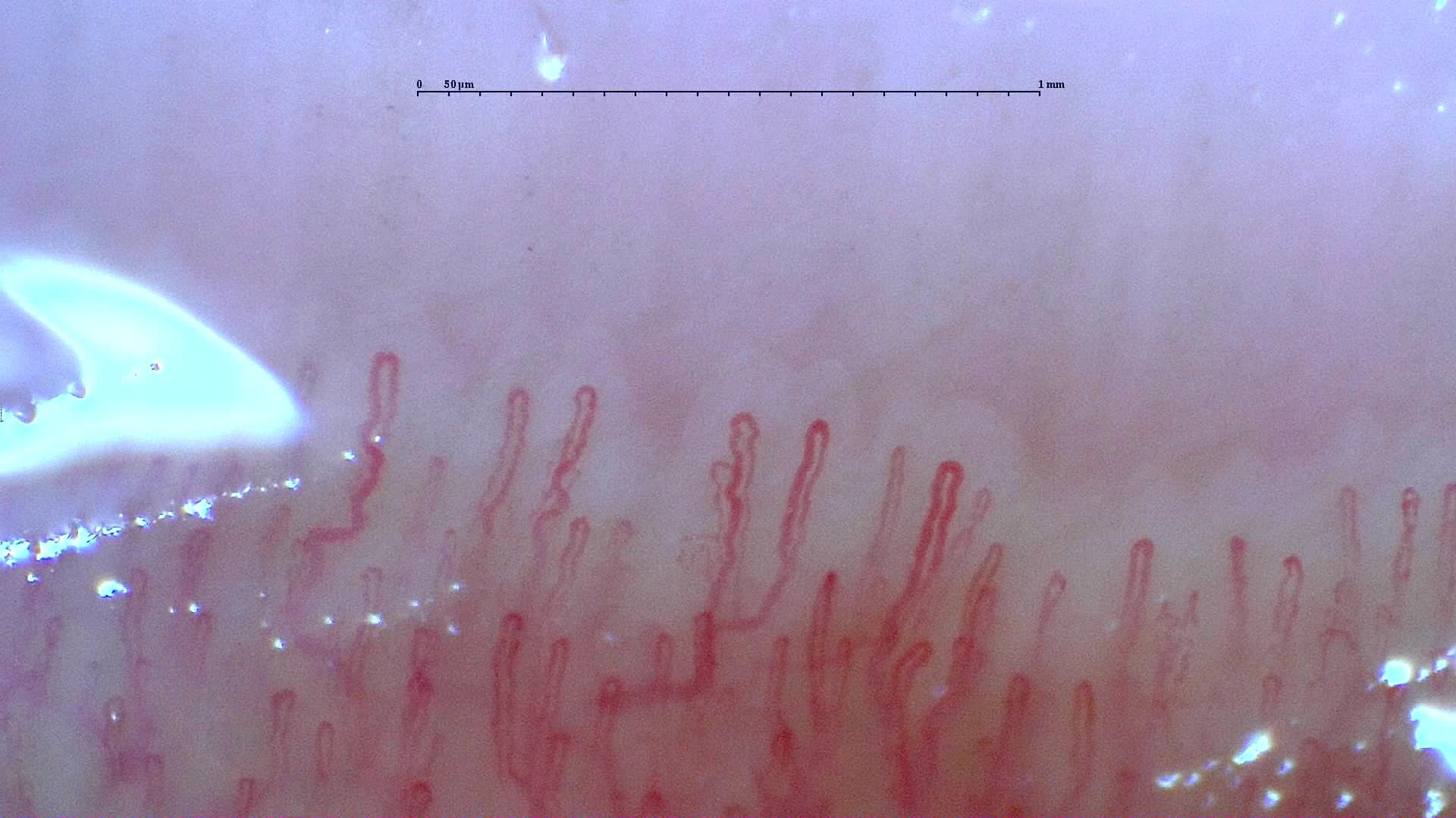 Nailfold capillaroscopy: left little finger, field b. Normal Pattern: Representative Case.