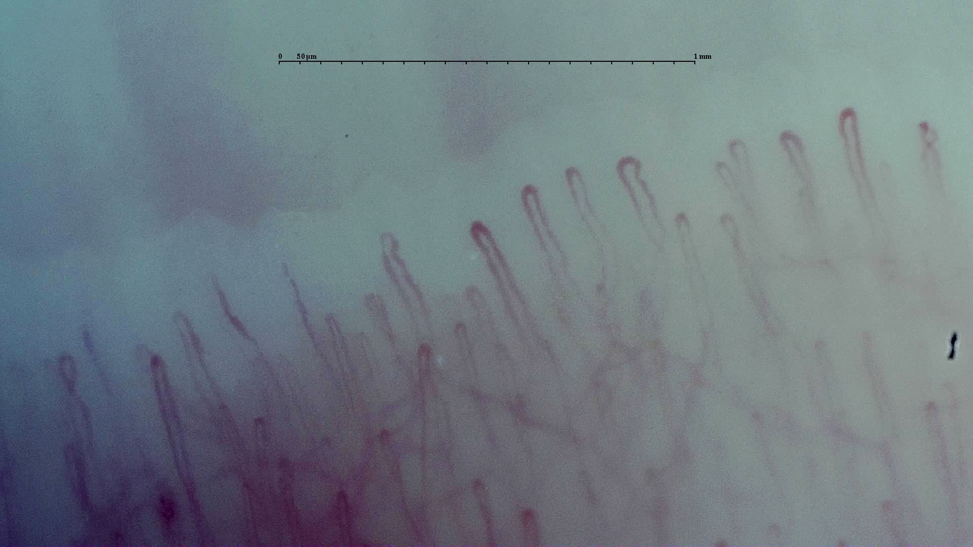 Nailfold capillaroscopy: right ring finger, field c. Early SSc Cutolo Pattern: Representative Case.
