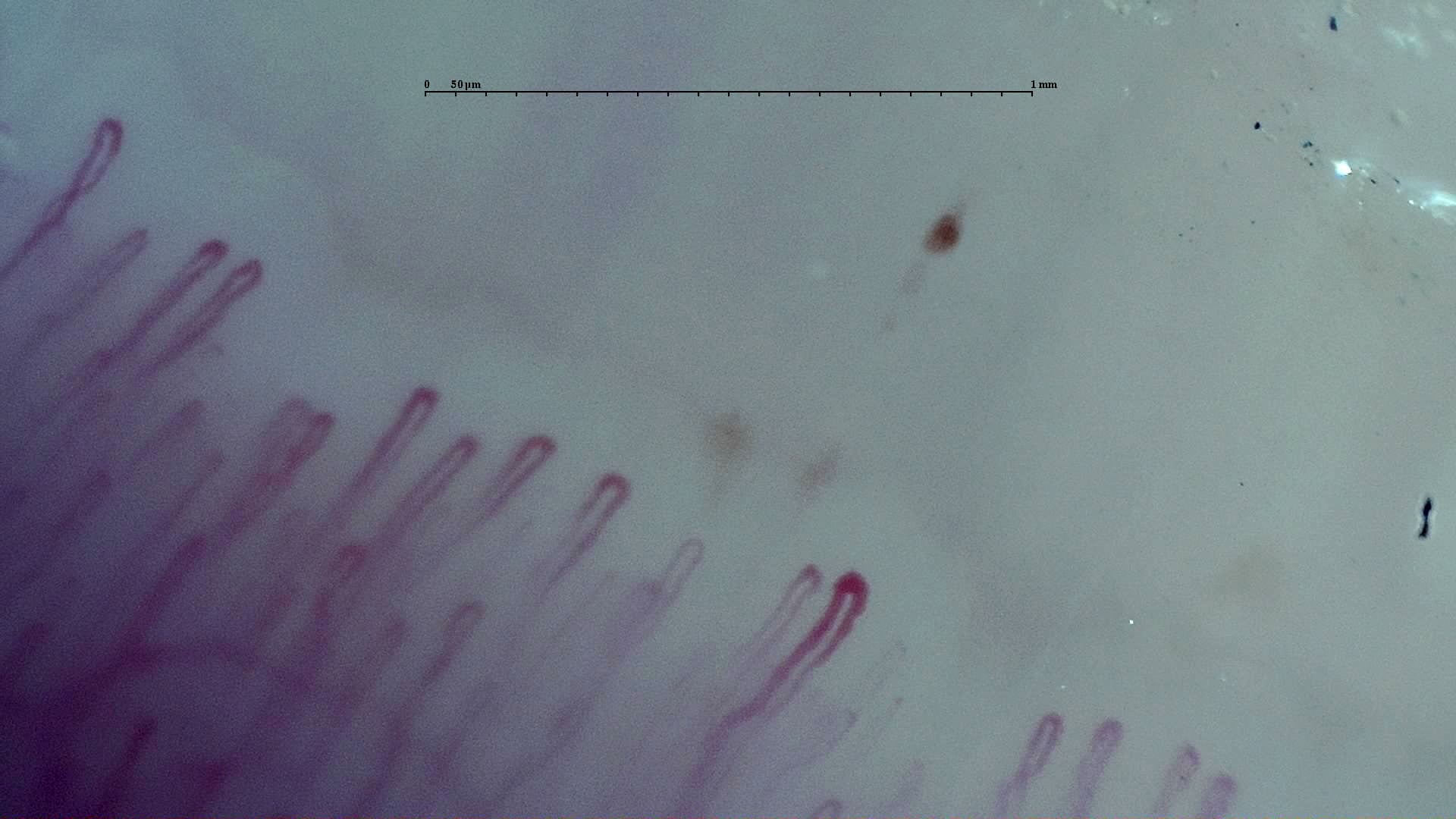 Nailfold capillaroscopy: right index finger, field b. Early SSc Cutolo Pattern: Representative Case.
