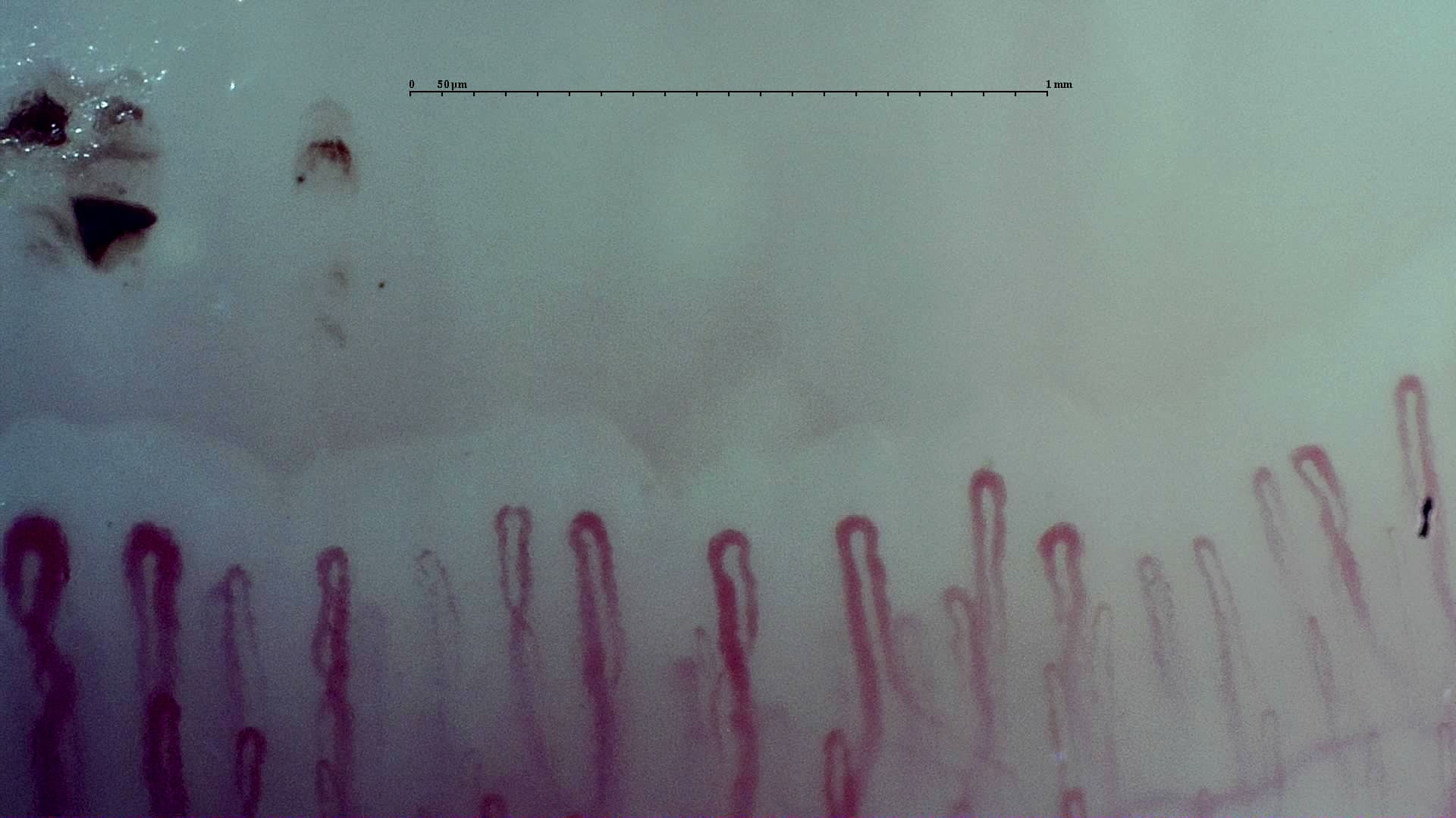 Nailfold capillaroscopy: left middle finger, field d. Early SSc Cutolo Pattern: Representative Case.