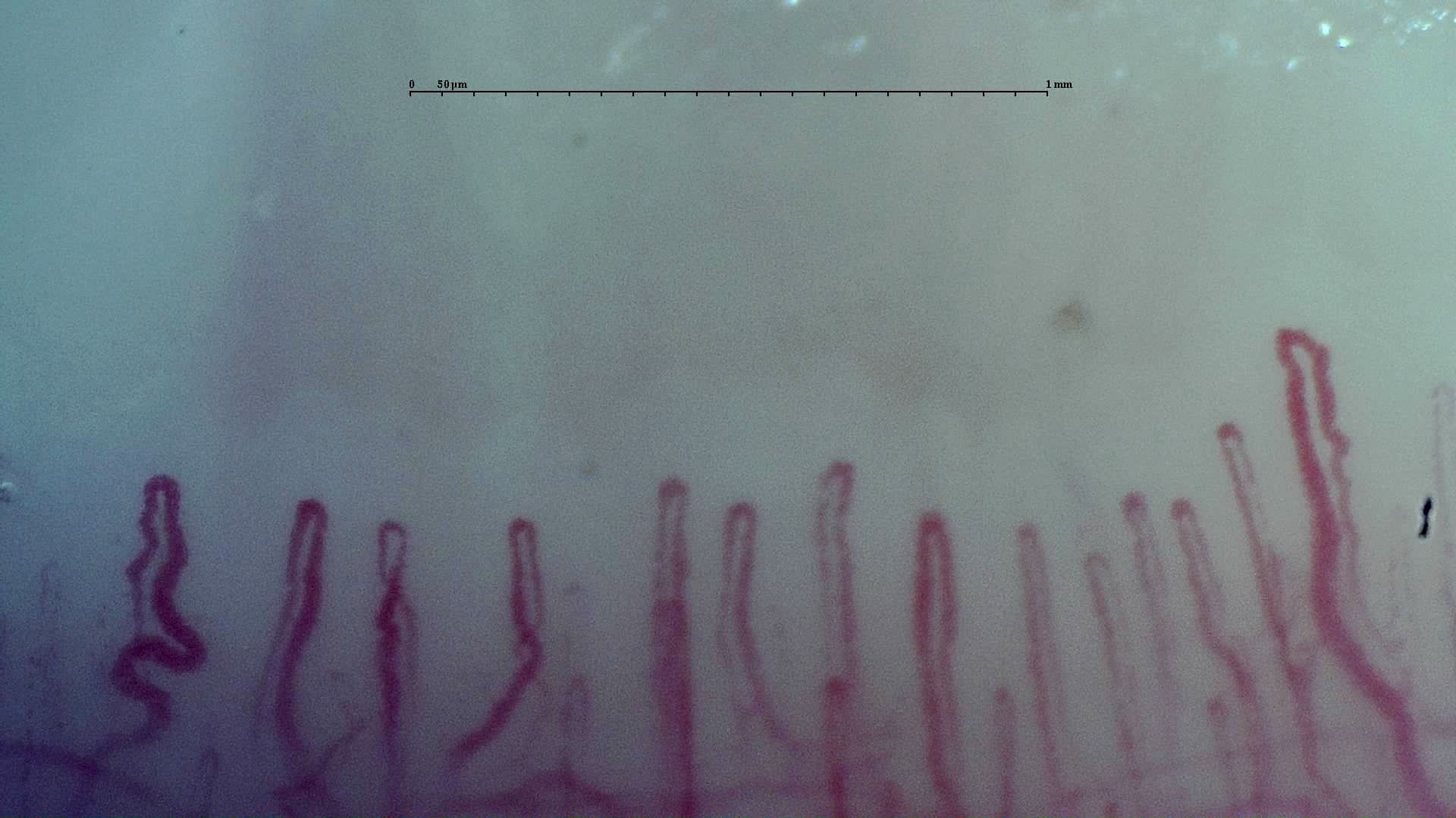 Nailfold capillaroscopy: left ring finger, field b. Early SSc Cutolo Pattern: Representative Case.