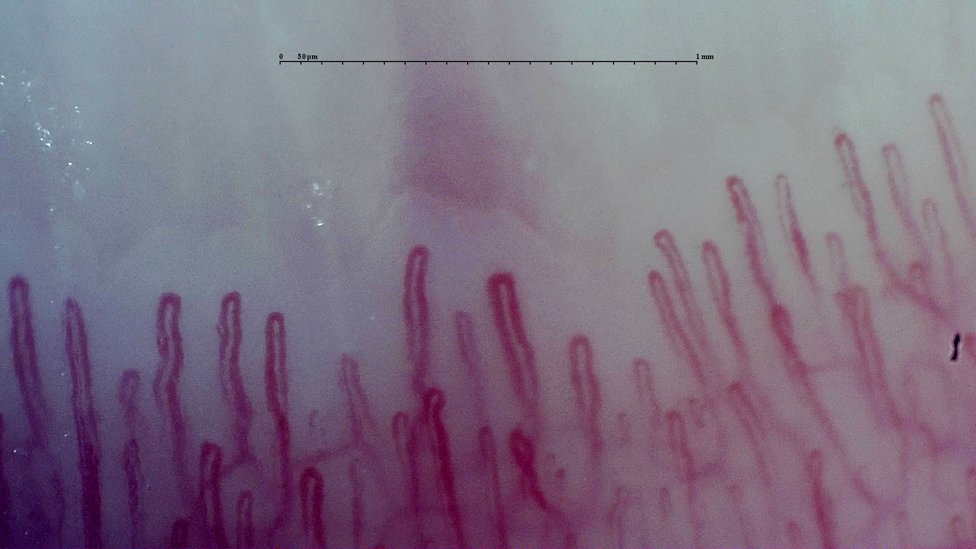 Nailfold capillaroscopy: left little finger, field c. Early SSc Cutolo Pattern: Representative Case.