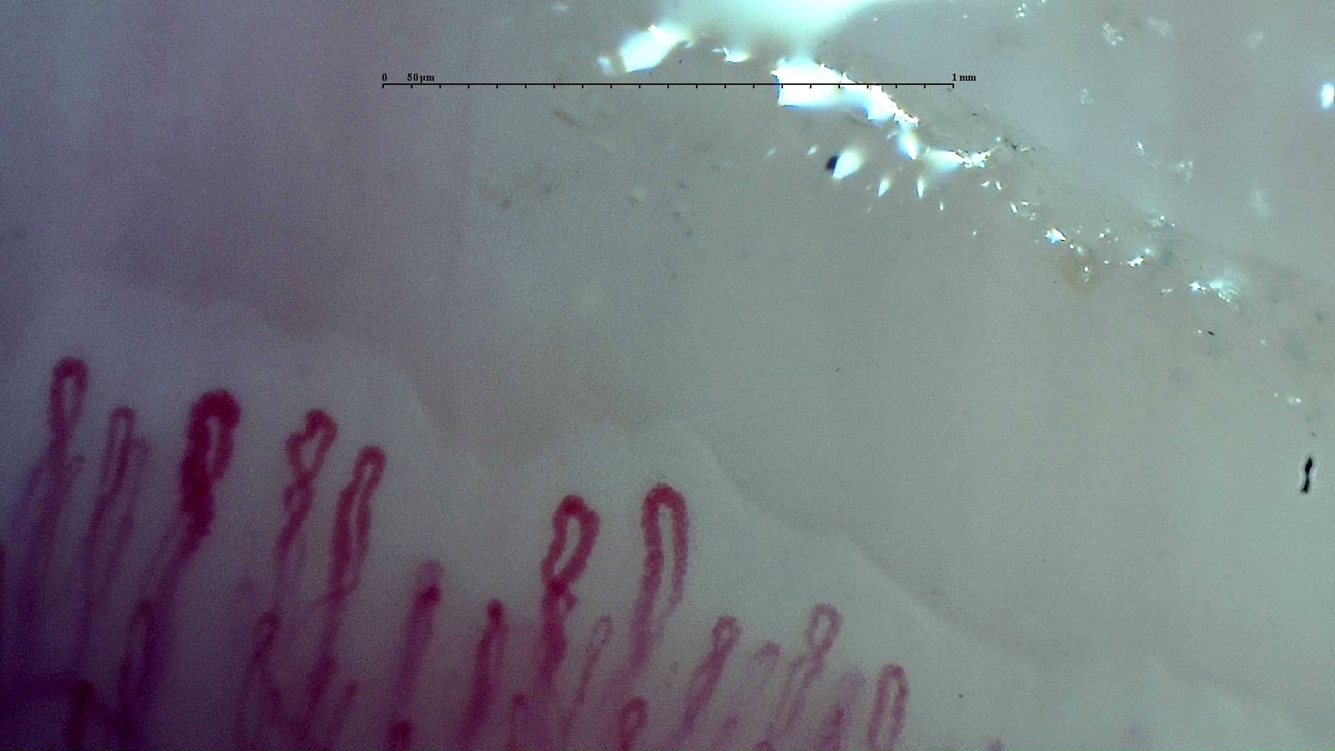 Nailfold capillaroscopy: left index finger, field b. Early SSc Cutolo Pattern: Representative Case.