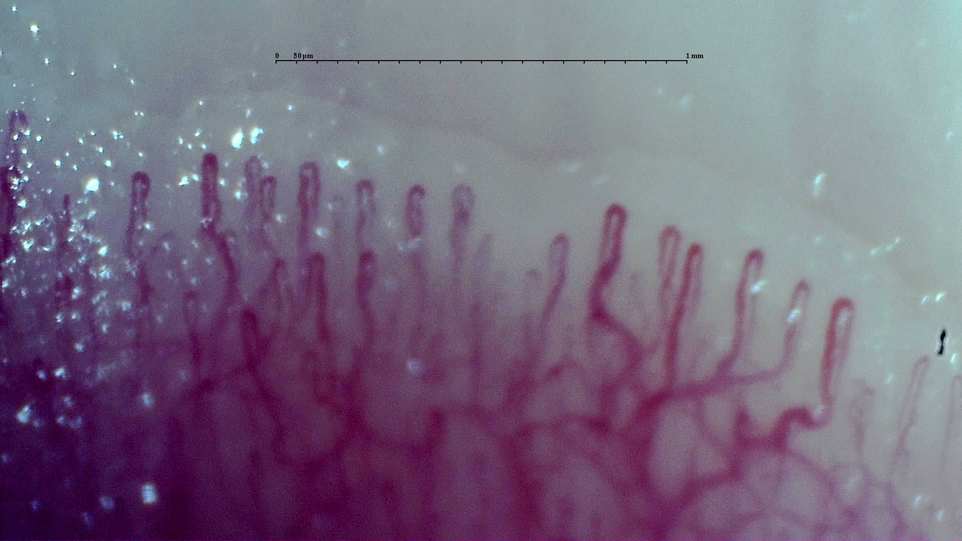 Nailfold capillaroscopy: left little finger, field a. Early SSc Cutolo Pattern: Representative Case.