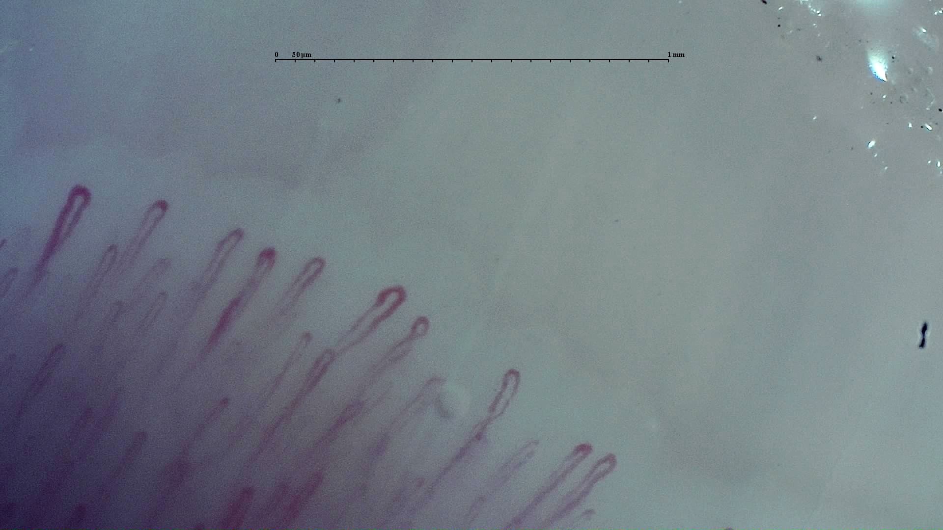 Nailfold capillaroscopy: right index finger, field c. Early SSc Cutolo Pattern: Representative Case.