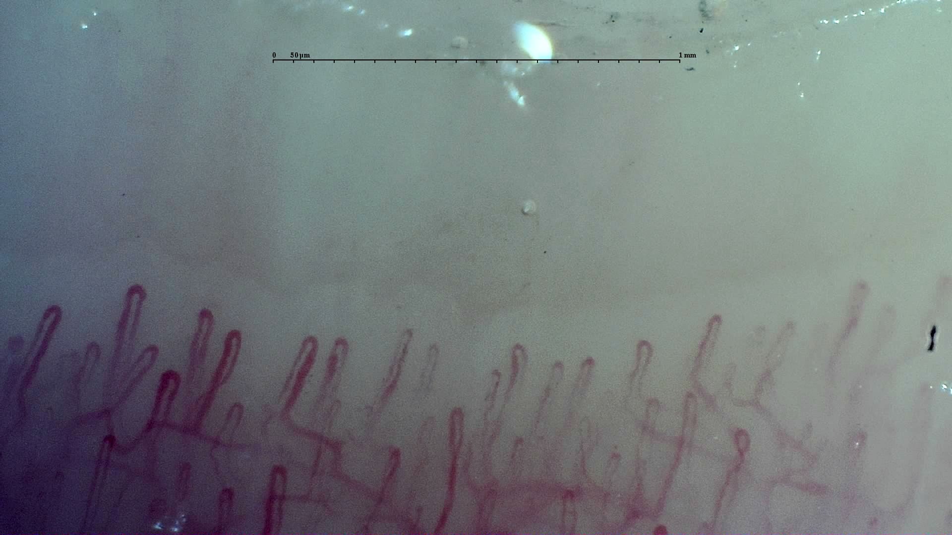 Nailfold capillaroscopy: right little finger, field a. Early SSc Cutolo Pattern: Representative Case.
