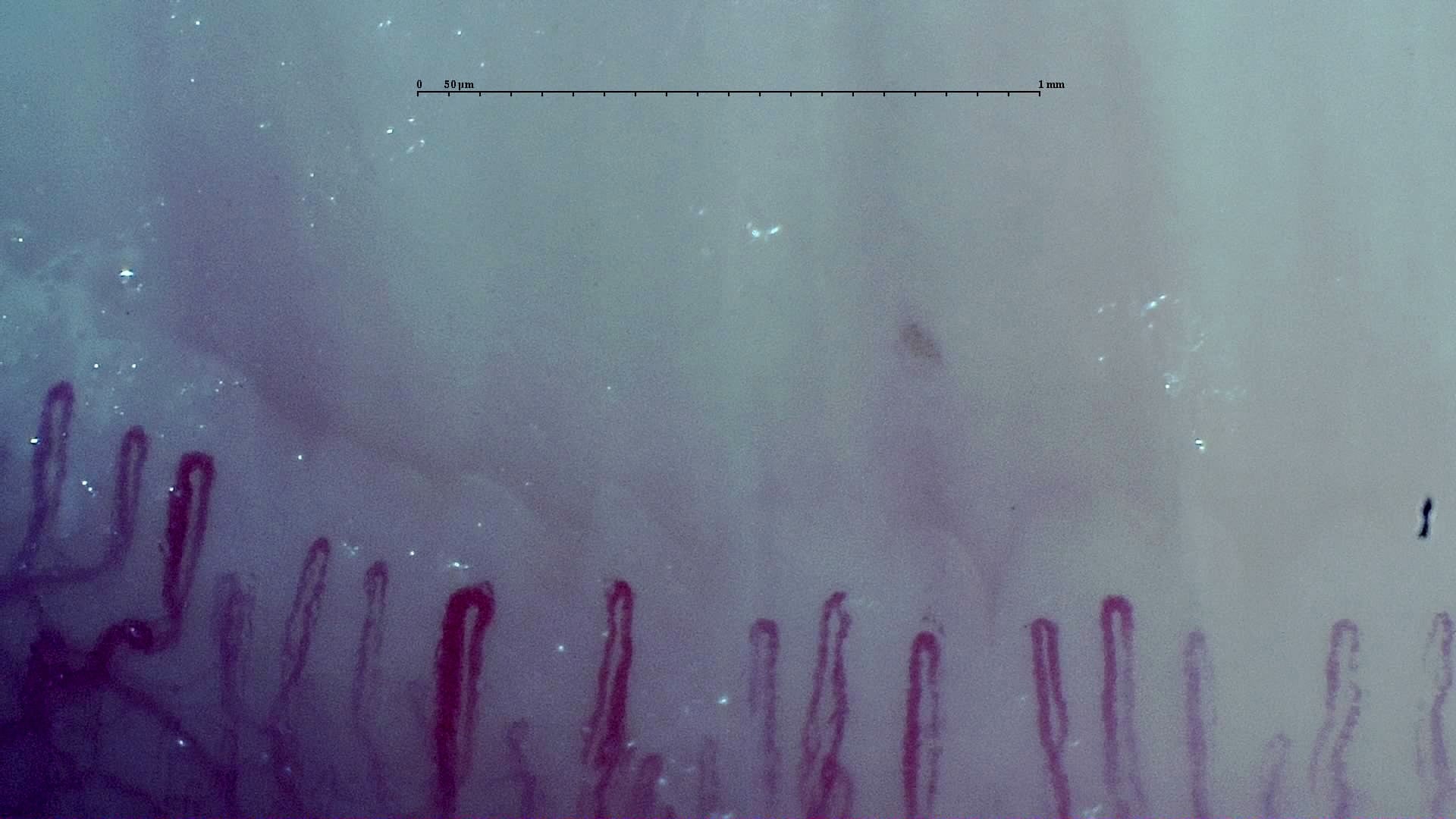 Nailfold capillaroscopy: left little finger, field b. Early SSc Cutolo Pattern: Representative Case.