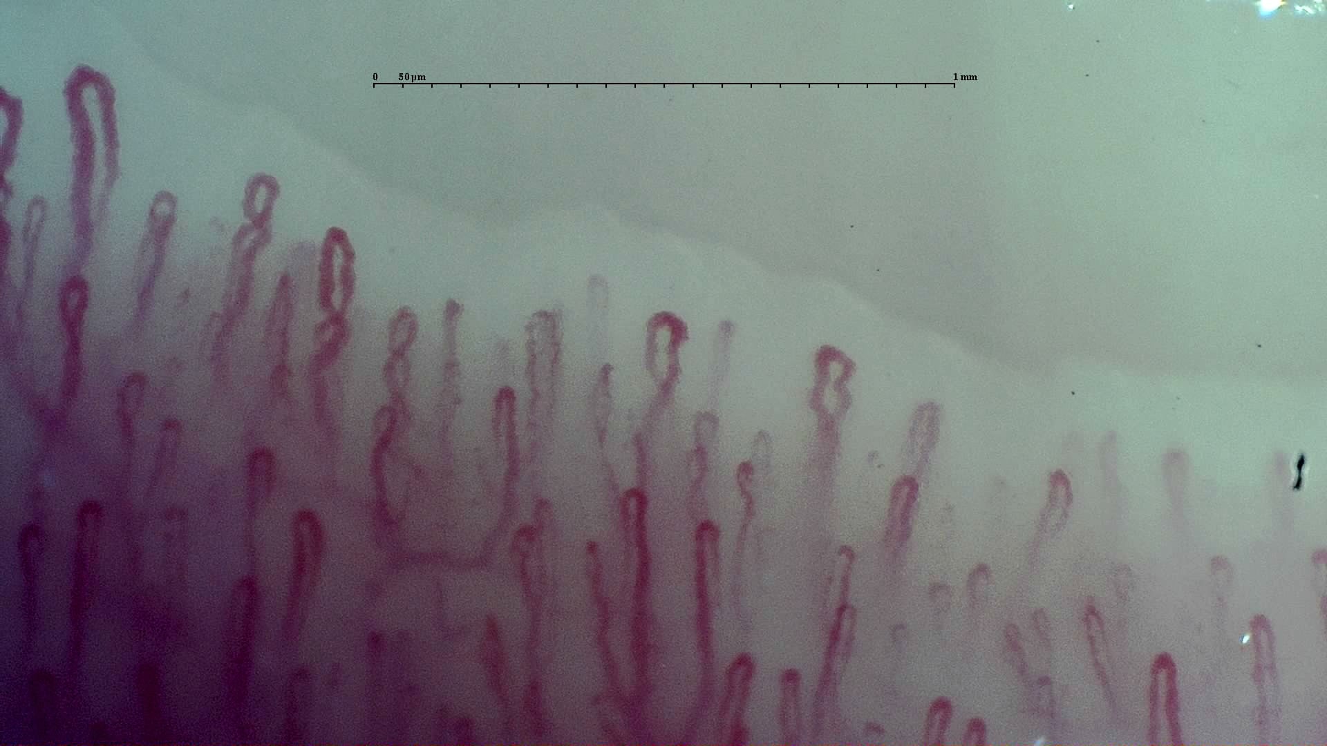 Nailfold capillaroscopy: left index finger, field c. Early SSc Cutolo Pattern: Representative Case.