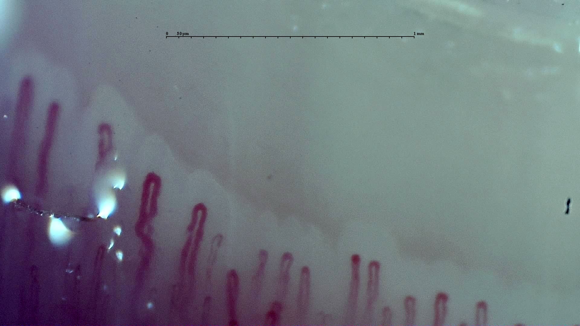 Nailfold capillaroscopy: left index finger, field a. Early SSc Cutolo Pattern: Representative Case.