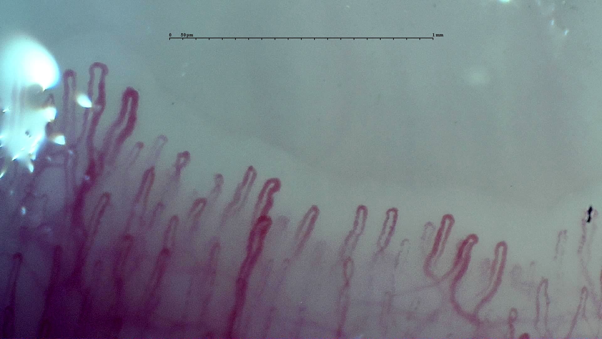 Nailfold capillaroscopy: right ring finger, field a. Early SSc Cutolo Pattern: Representative Case.
