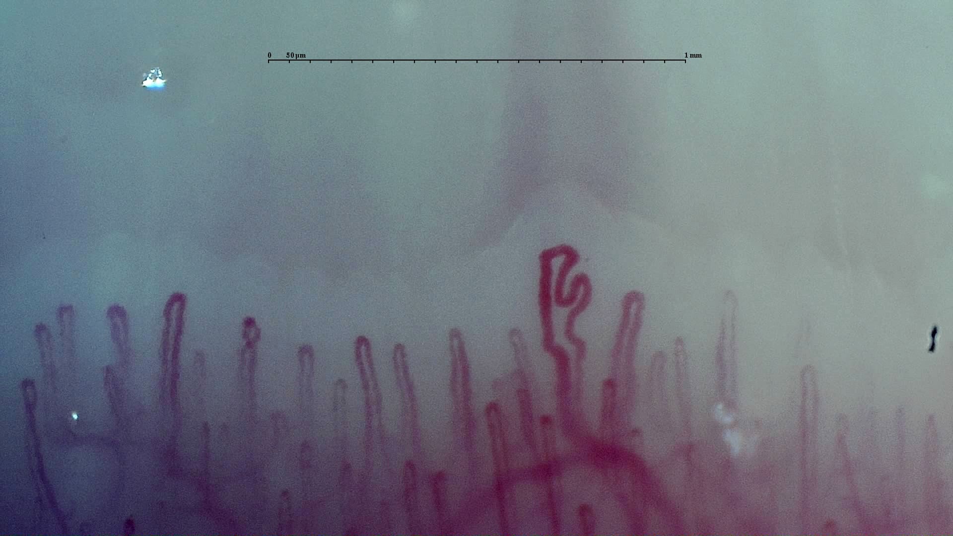 Nailfold capillaroscopy: right ring finger, field b. Early SSc Cutolo Pattern: Representative Case.