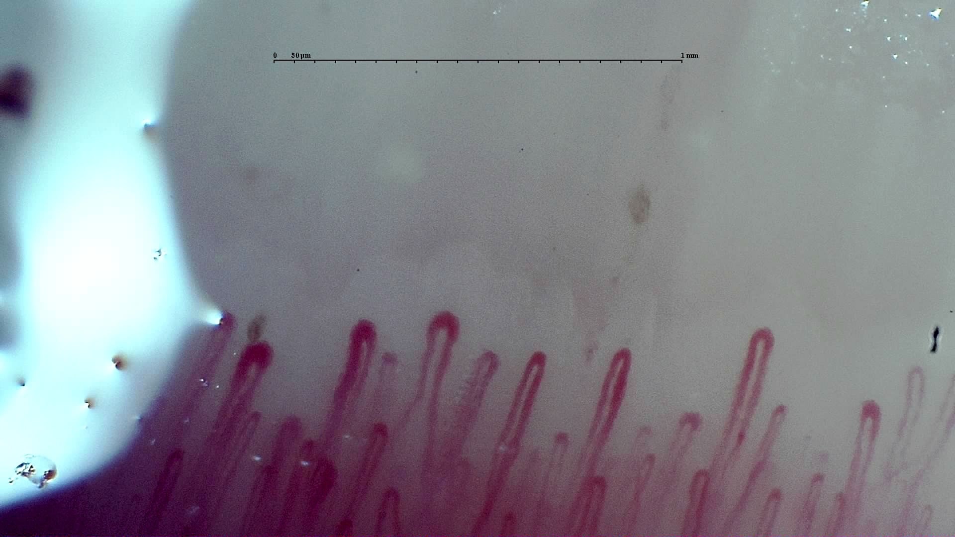 Nailfold capillaroscopy: right middle finger, field c. Early SSc Cutolo Pattern: Representative Case.