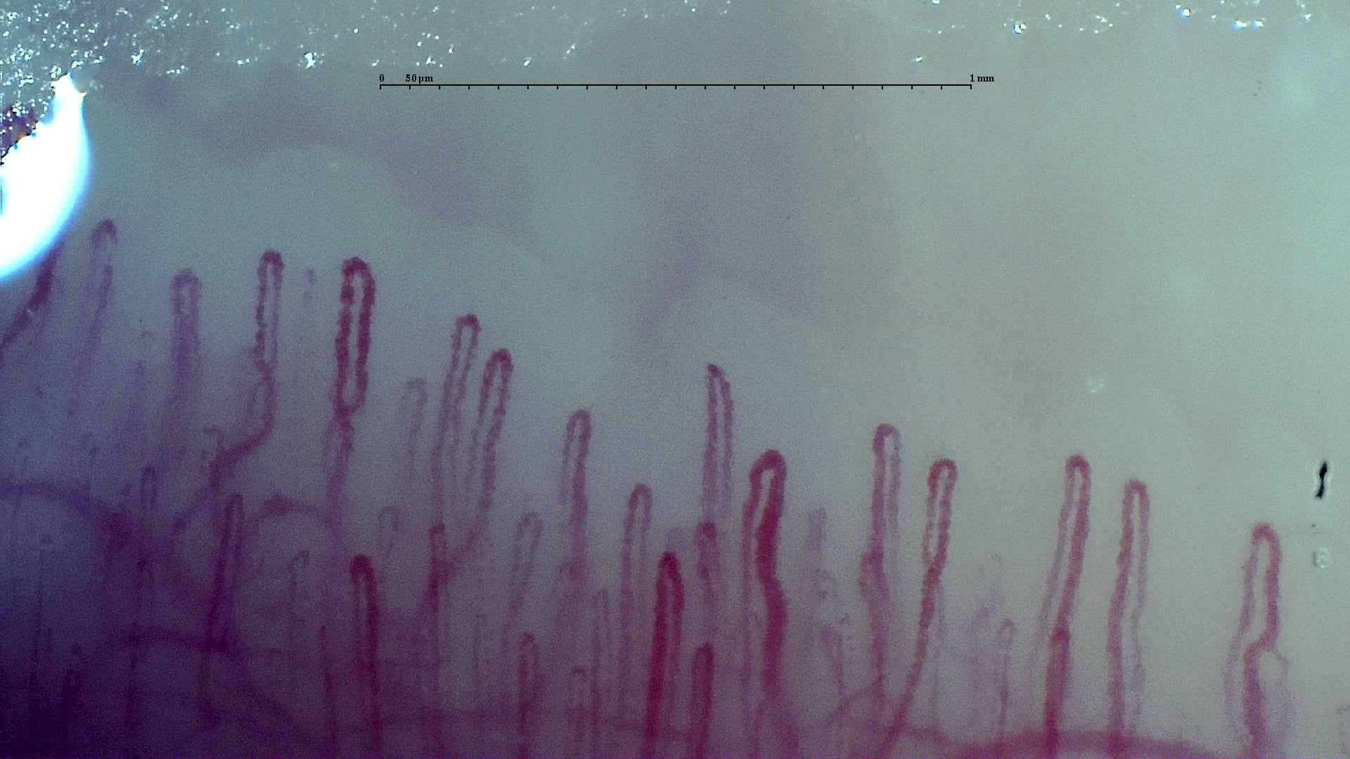 Nailfold capillaroscopy: left ring finger, field a. Early SSc Cutolo Pattern: Representative Case.