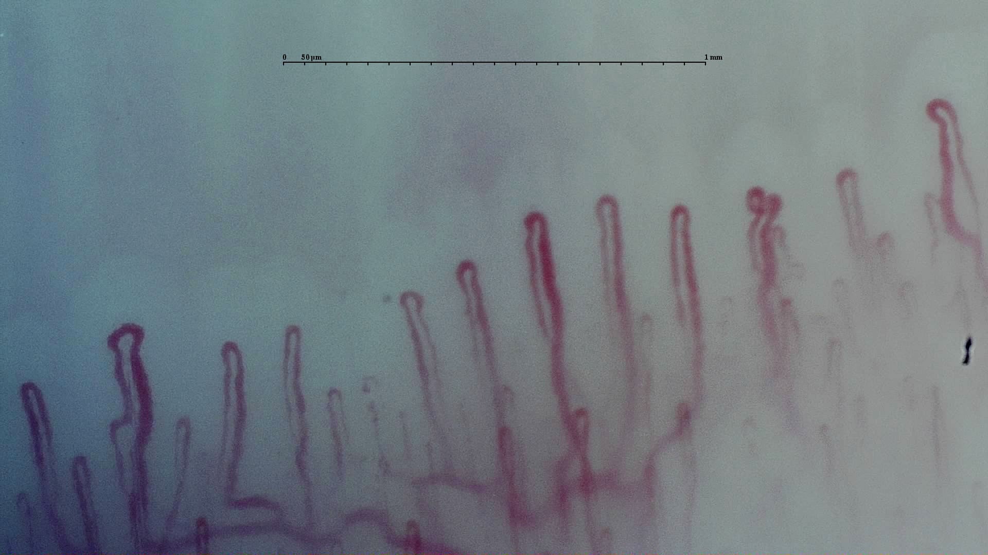 Nailfold capillaroscopy: left ring finger, field d. Early SSc Cutolo Pattern: Representative Case.