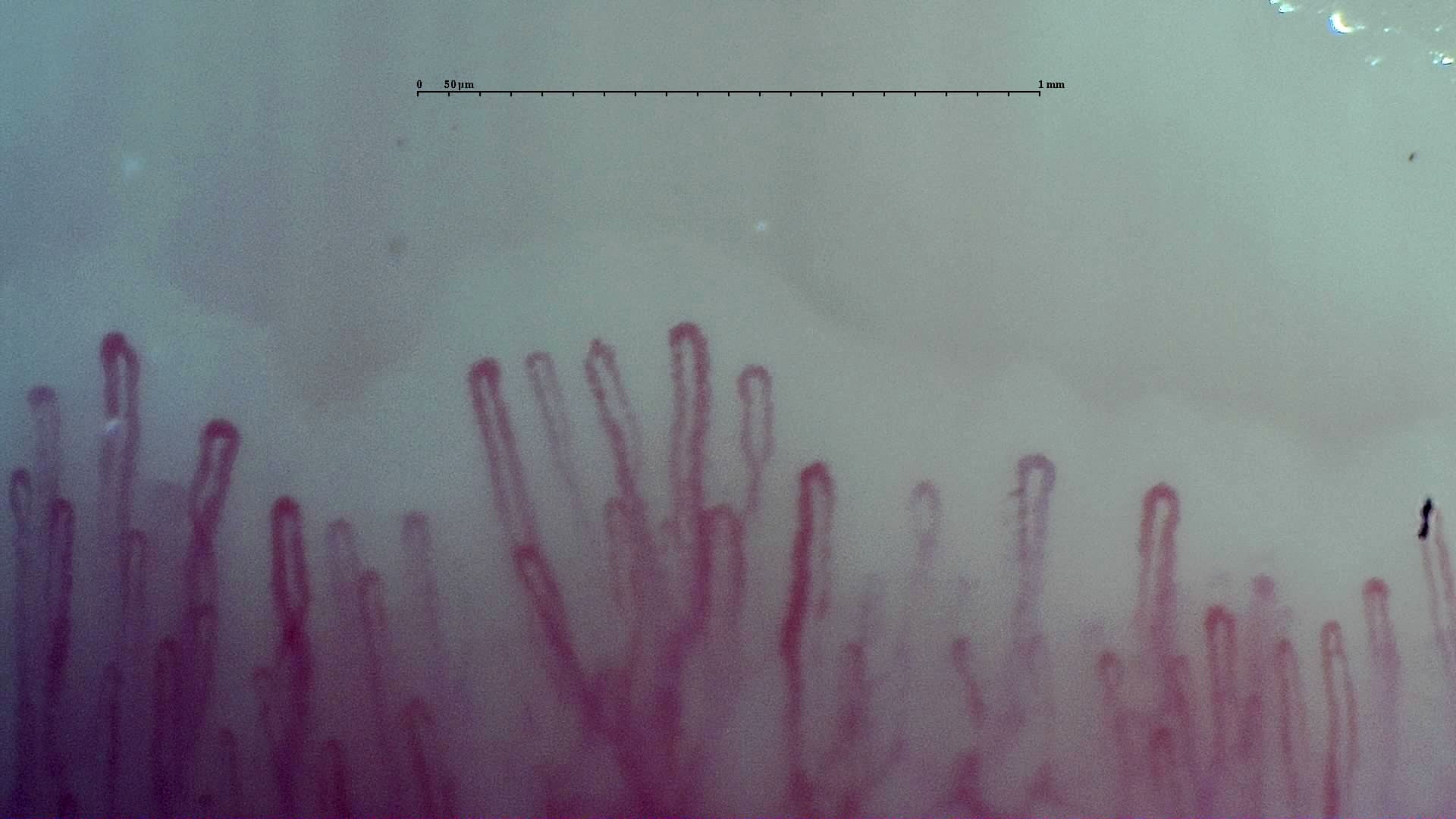 Nailfold capillaroscopy: left middle finger, field b. Early SSc Cutolo Pattern: Representative Case.