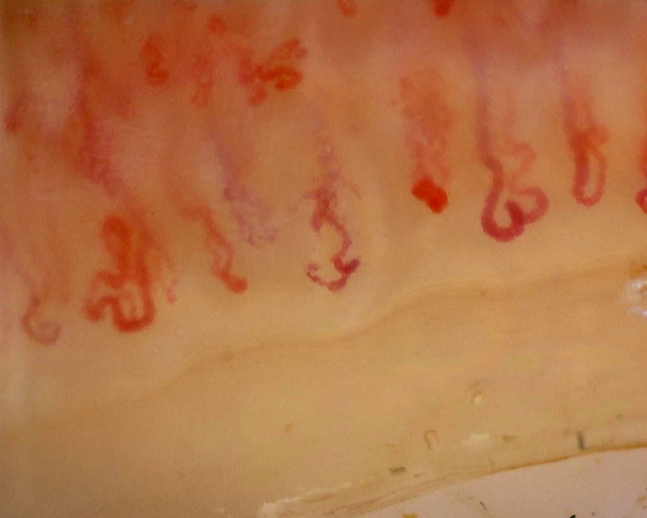 Nailfold capillaroscopy: right index finger, field d. Late SSc Cutolo Pattern: Representative Case.