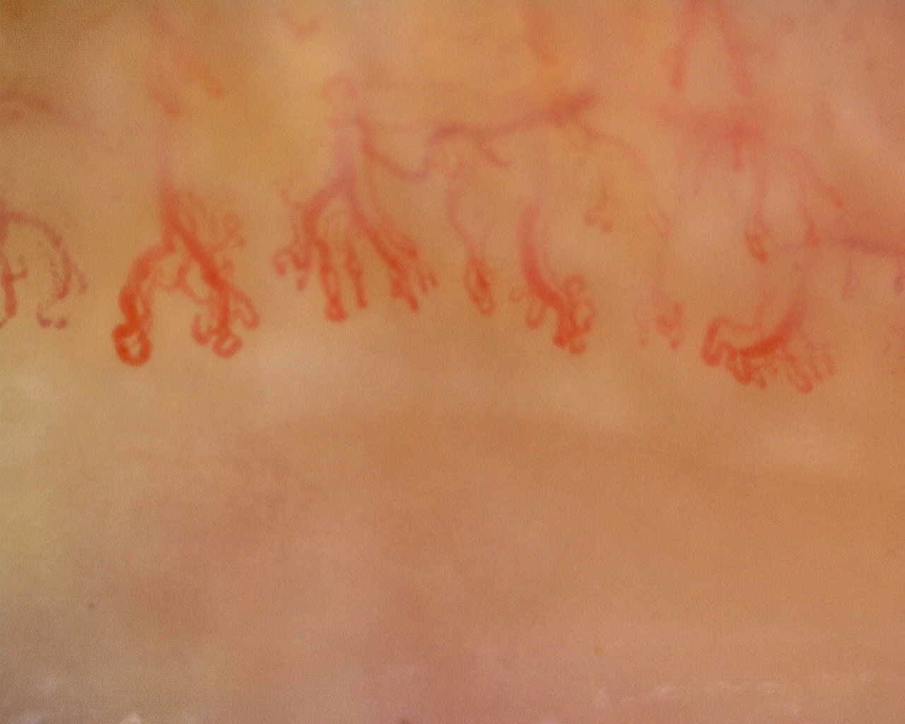 Nailfold capillaroscopy: right little finger, field a. Late SSc Cutolo Pattern: Representative Case.