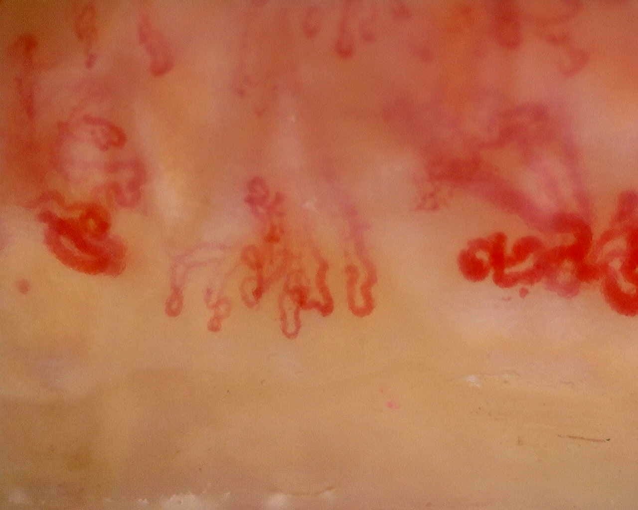 Nailfold capillaroscopy: left middle finger, field b. Late SSc Cutolo Pattern: Representative Case.