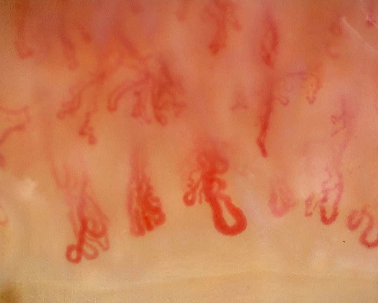 Nailfold capillaroscopy: right middle finger, field b. Late SSc Cutolo Pattern: Representative Case.