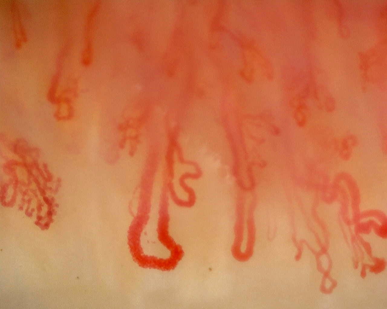 Nailfold capillaroscopy: right ring finger, field d. Late SSc Cutolo Pattern: Representative Case.