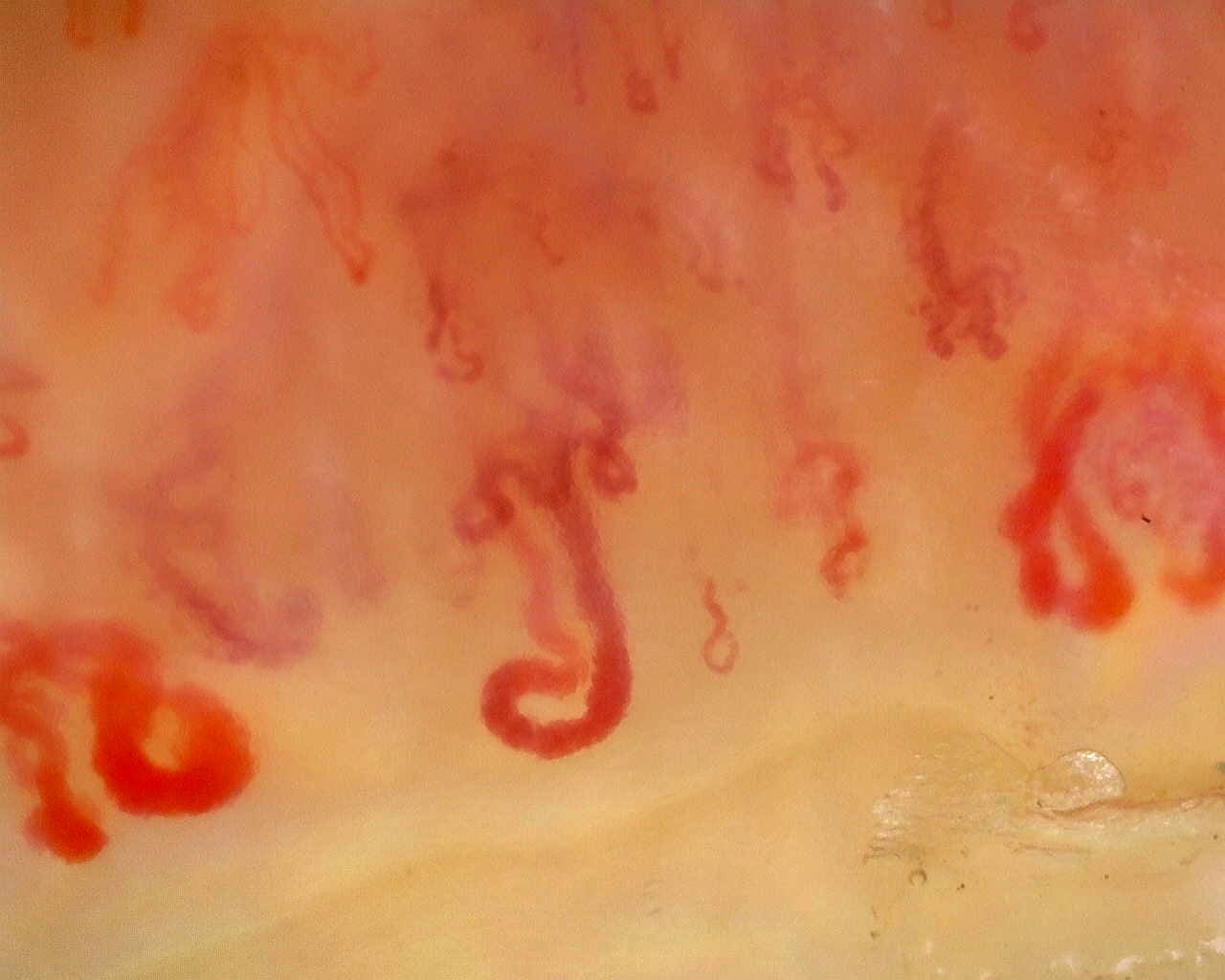 Nailfold capillaroscopy: right middle finger, field d. Late SSc Cutolo Pattern: Representative Case.