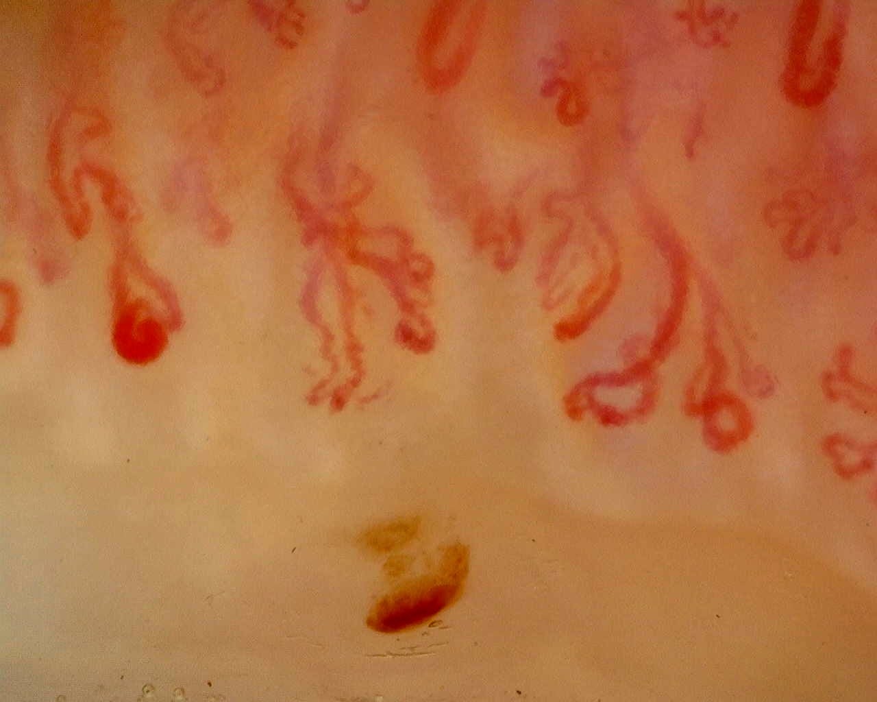 Nailfold capillaroscopy: right index finger, field a. Late SSc Cutolo Pattern: Representative Case.
