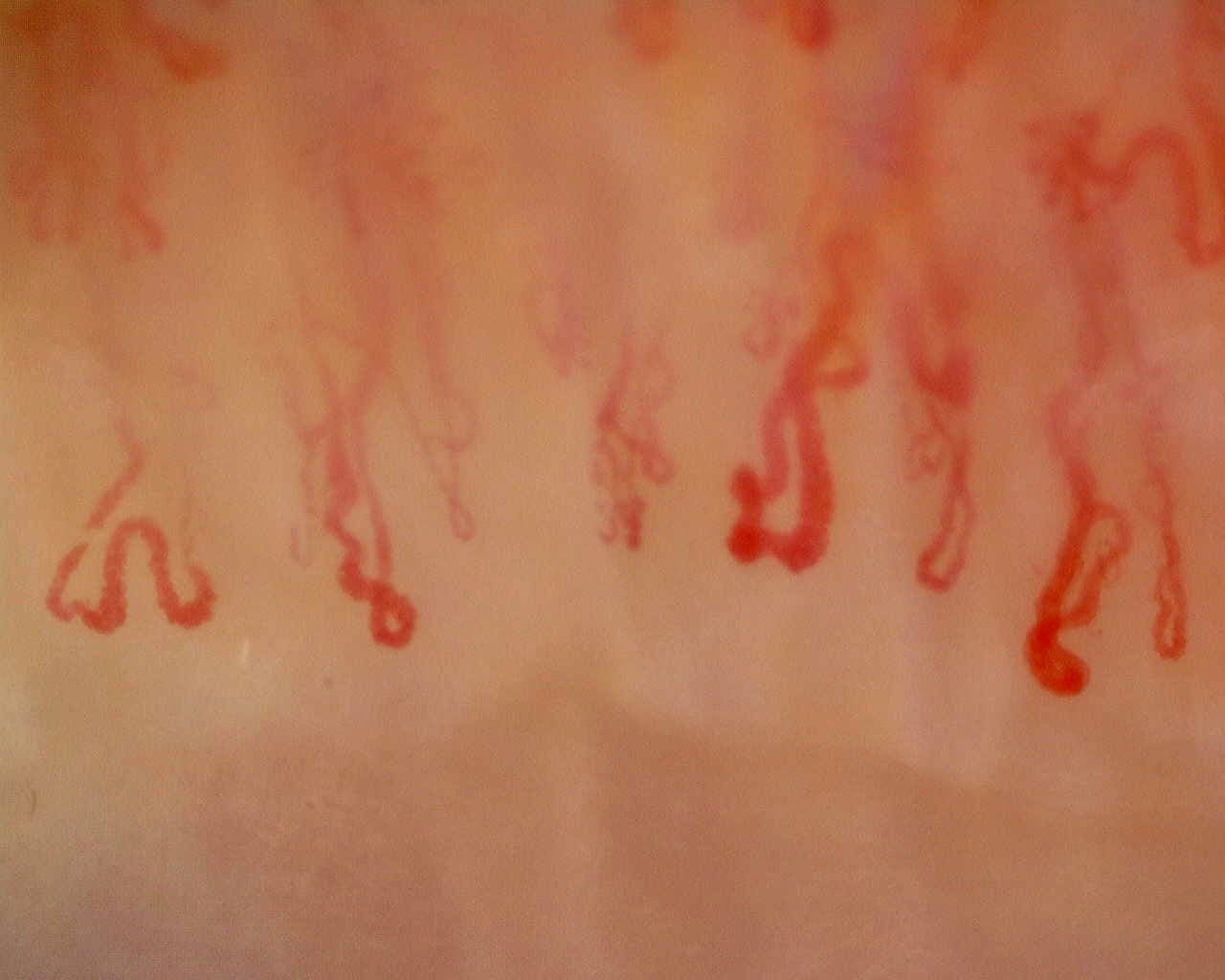 Nailfold capillaroscopy: right ring finger, field a. Late SSc Cutolo Pattern: Representative Case.