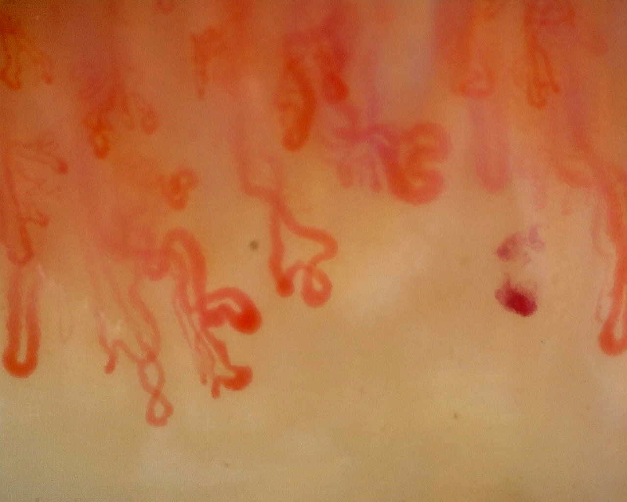 Nailfold capillaroscopy: right ring finger, field c. Late SSc Cutolo Pattern: Representative Case.